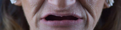 artigo blog beclinique 953x412 implantes dentários