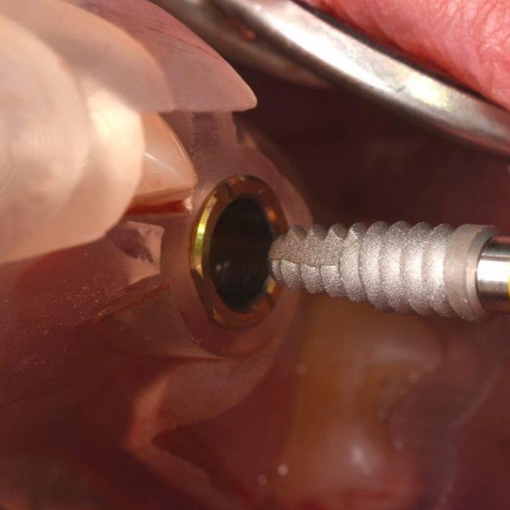 Implantes Dentários