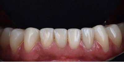 Facetas Dentárias