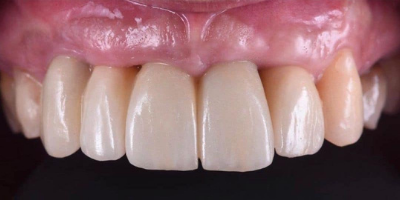 Implantes Dentários