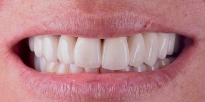Implantes Dentários