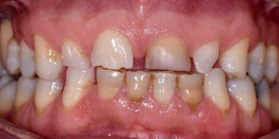 Facetas Dentárias