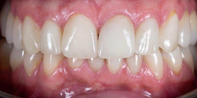 Facetas Dentárias