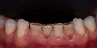 Facetas Dentárias