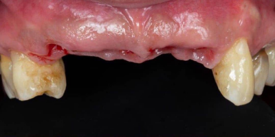 Implantes Dentários