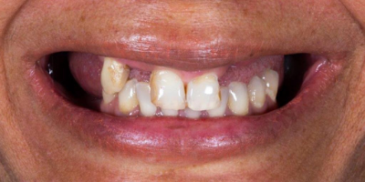 Implantes Dentários