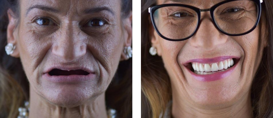 Implantes dentários: o novo sorriso da Rosa