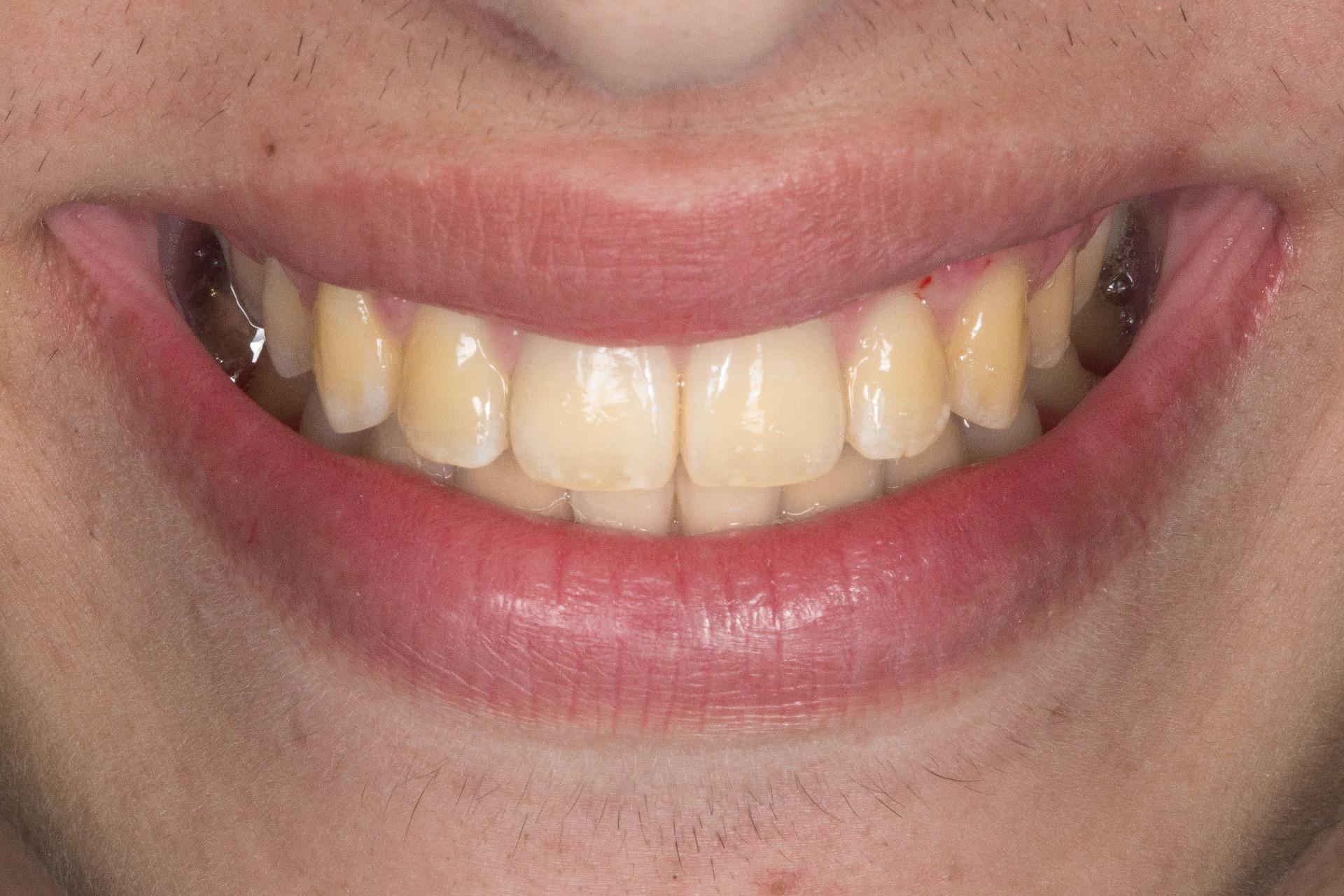 clinical case before and after beclinique