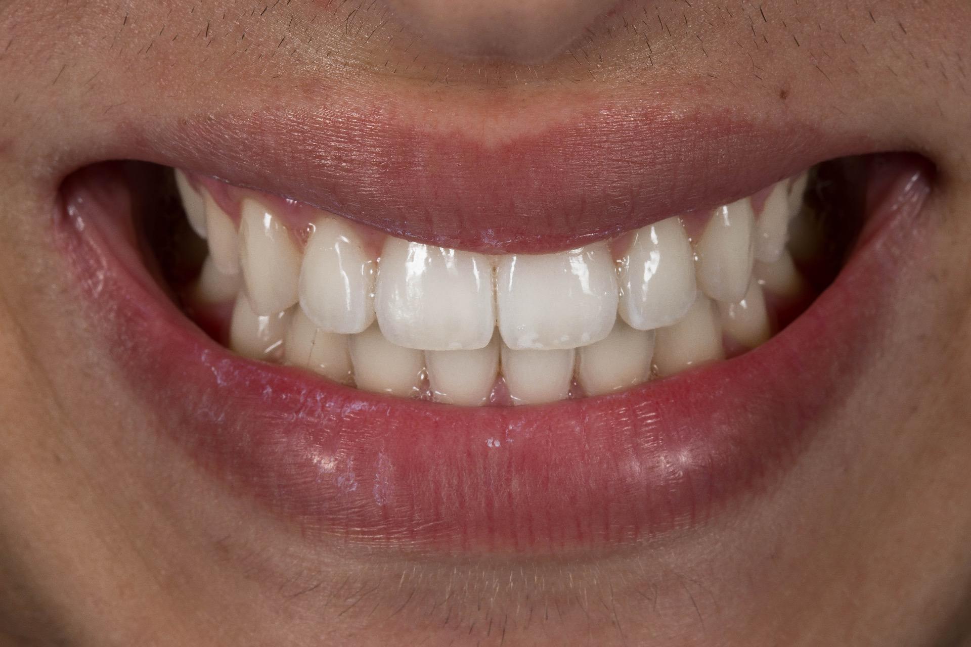 clinical case before and after beclinique
