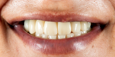 beclinique implantes dentários