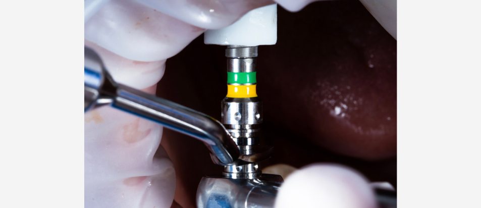 beclinique artigo blog #2 dentes em 1 dia tecnologia