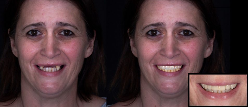 beclinique artigo blog #2 dentes em 1 dia tecnologia