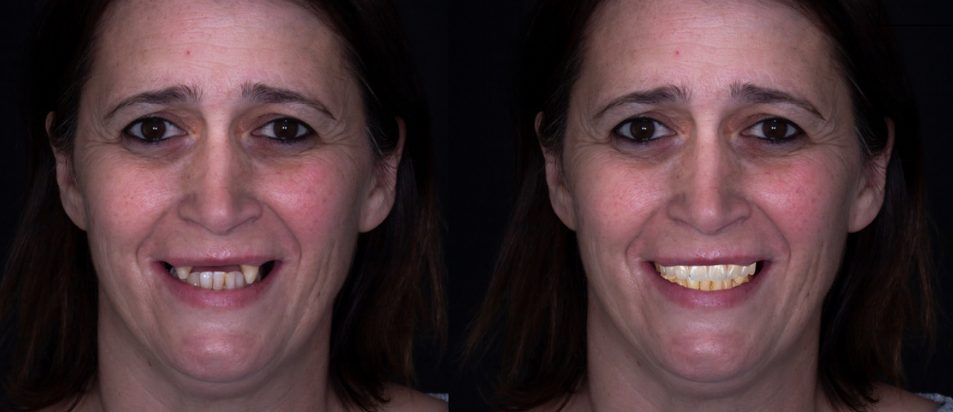 beclinique artigo blog #2 dentes em 1 dia tecnologia