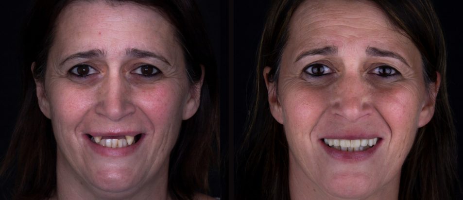 beclinique artigo blog #2 dentes em 1 dia tecnologia