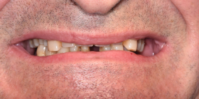 beclinique dentes em 1 dia depois
