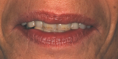 beclinique dentes em 1 dia depois