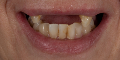 beclinique dentes em 1 dia depois