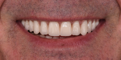 beclinique dentes em 1 dia depois