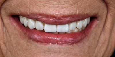 beclinique dentes em 1 dia depois