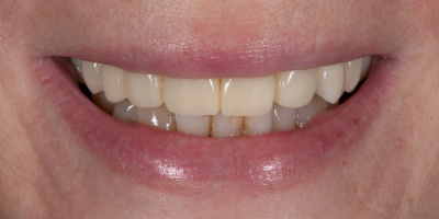 beclinique dentes em 1 dia depois