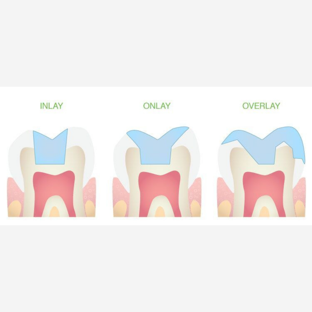 beclinique inlays onlays overlays