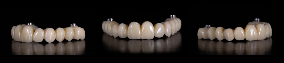 beclinique artigo blog #2 dentes em 1 dia tecnologia