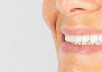 Facetas Dentárias — Caso Clínico #1