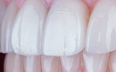 Facetas dentárias: a solução simples para um sorriso bonito