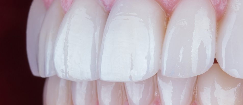 Facetas Dentárias - Beclinique - Blog