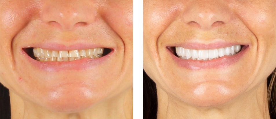 Facetas Dentárias - Antes e Depois Zoom - Beclinique