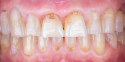 Sorriso com facetas dentárias