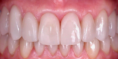 Sorriso com facetas dentárias