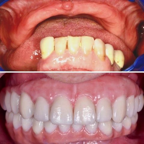 Manuela Implantes Zigómaticos Antes e Depois