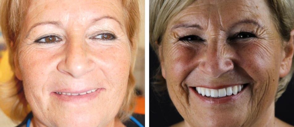 Antes e Depois beclinique caso clínico dentes em 1 dia #2