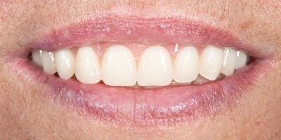Laurinda Depois Implantes Dentários