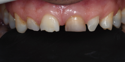 Dental-Veneers-Francisco-After