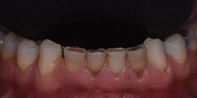 Dental-veneers-Francisco-Before-maxillary-superior