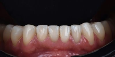 Dental-veneers-Francisco-Before-maxillary-superior