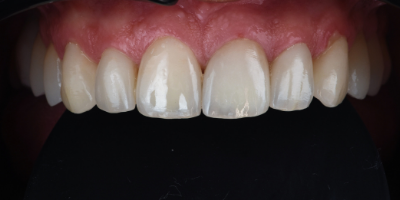 Dental-Veneers-Francisco-After
