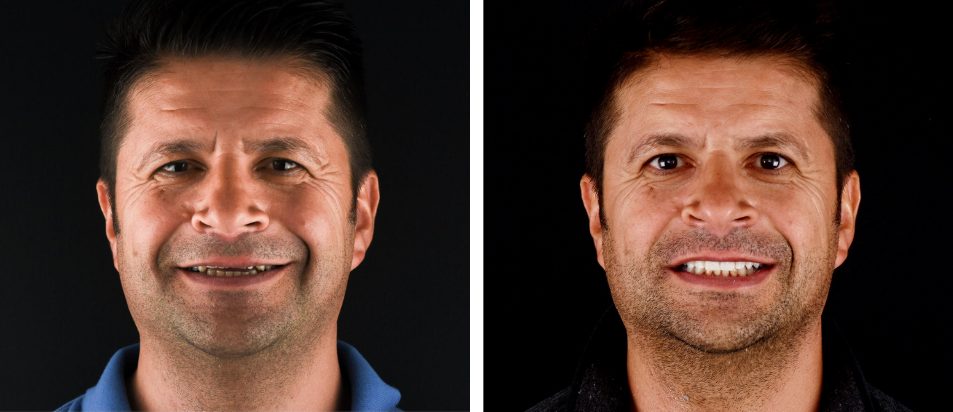 facetas-dentaria-antes-depois-francisco