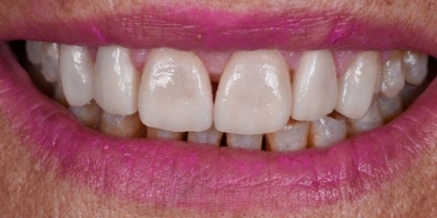Site beclinique coroas dentarias dissilicato caso clinico Maria caso Antes Depois