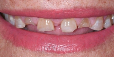 Site beclinique coroas dentarias dissilicato caso clinico Maria caso Antes Depois