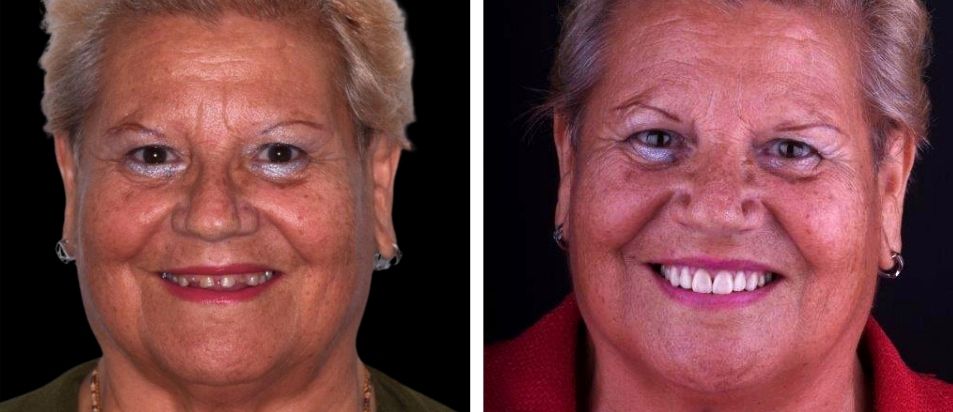 beclinique coroas dentarias dissilicato caso clinico Maria
