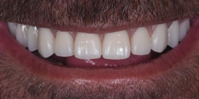 Clinica Dentária Beclinique Implante Dentário Cristovão