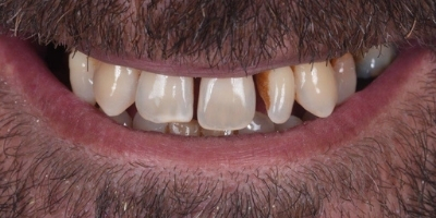 Clinica Dentária Beclinique Implante Dentário Cristovão