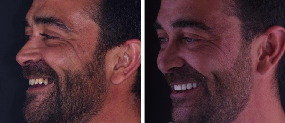 Clinica Dentária Beclinique Implante Dentário Cristovão