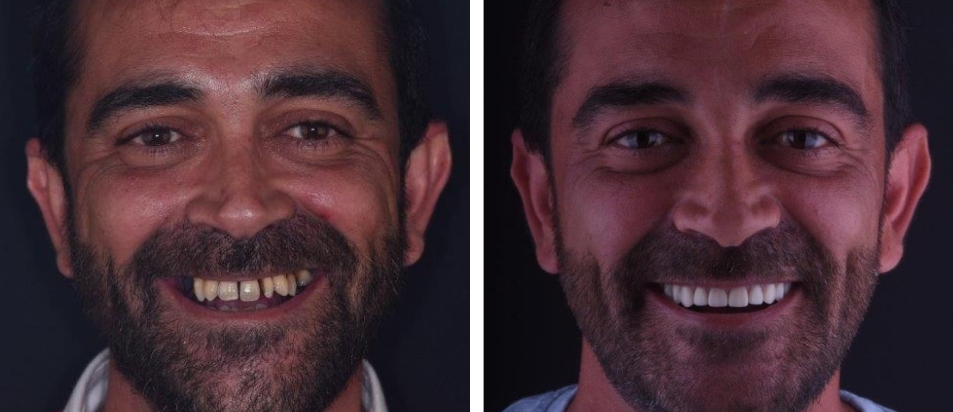 Clinica Dentária Beclinique Implante Dentário Cristovão