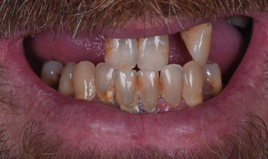 Clinica Dentária Beclinique Implante Dentário Cristovão