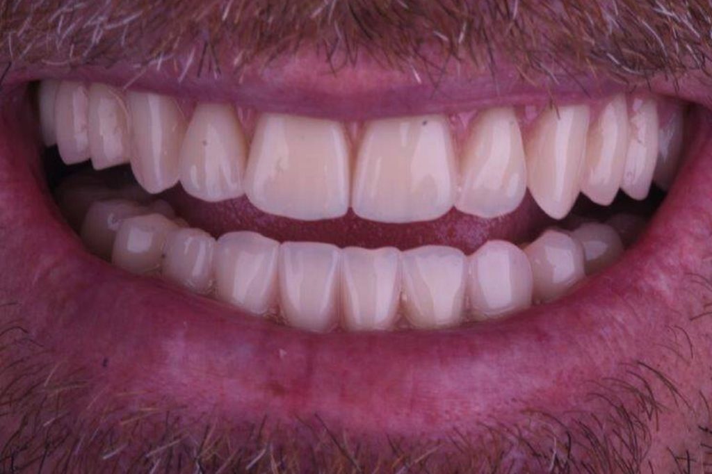 Clinica Dentária Beclinique Implante Dentário Cristovão