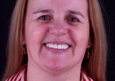 Implantes Dentários – Maria João